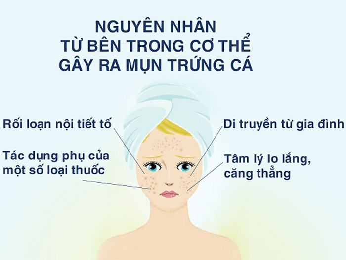 Nguyên nhân gây mụn