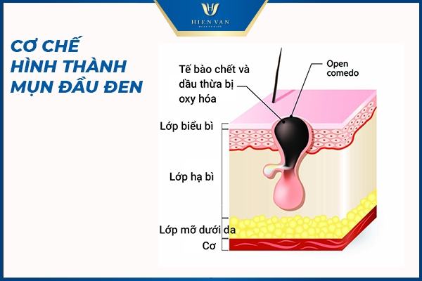 Mụn đầu đen là gì? Nguyên nhân gây mụn đầu đen và giải pháp trị mụn an toàn Mụn đầu đen là gì? Nguyên nhân gây mụn đầu đen và giải pháp trị mụn an toàn